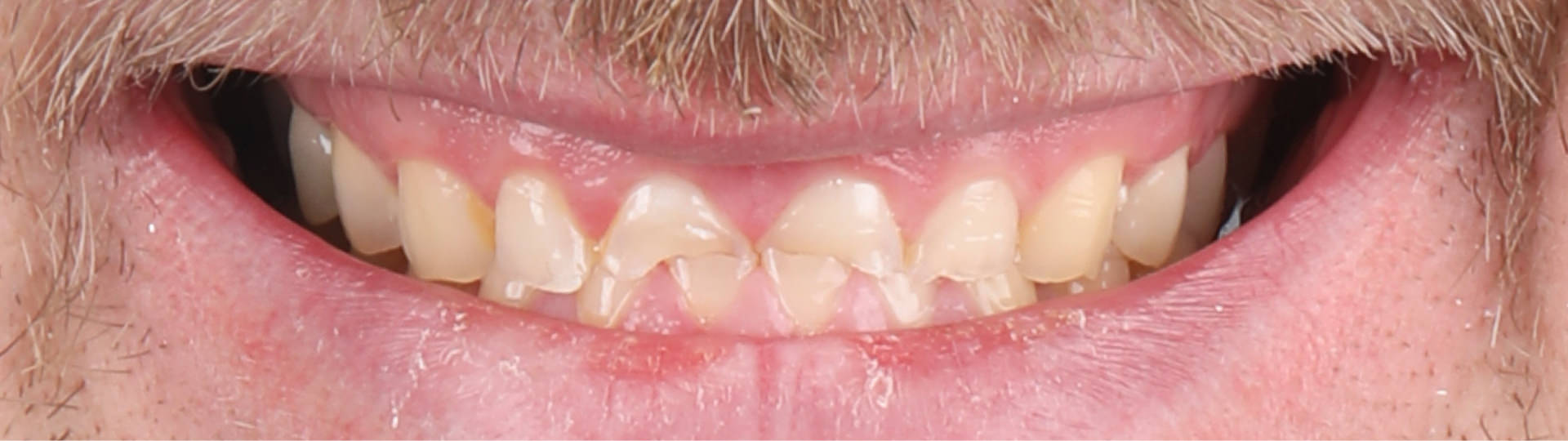 Zahnarzt Krefeld - Dr. Johannes Boldt - Leistungen - Veneers vorher