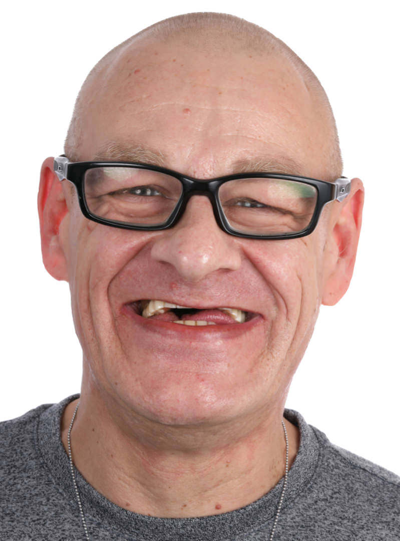 Zahnarzt Krefeld - Dr. Johannes Boldt - Leistungen - Implantate vorher